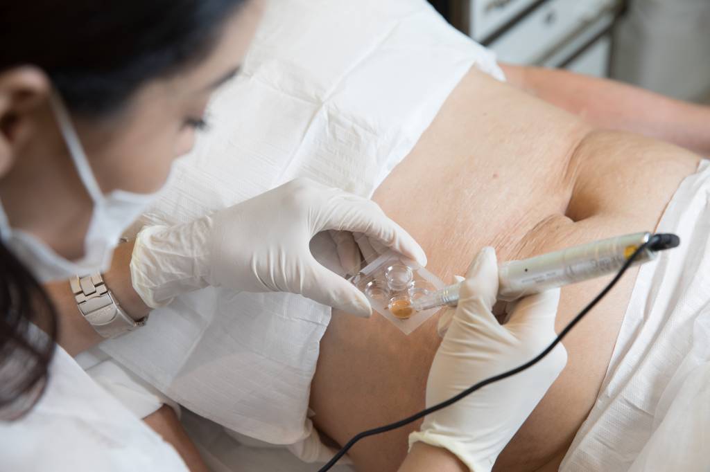 Micropigmentação para estrias conquista adeptas cariocas