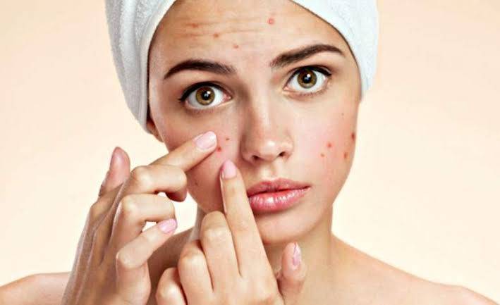 Primeira receita: Acne na adolescência