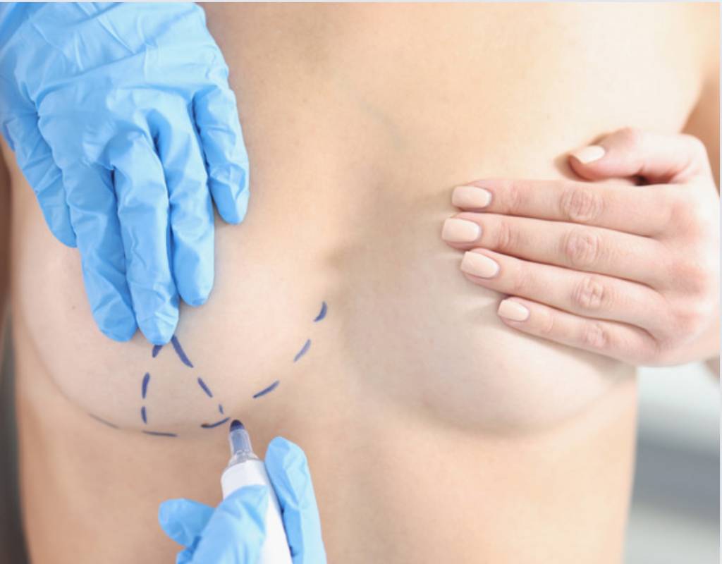 De Juliette a MC Mirella: lifting dos seios vira queridinho das famosas