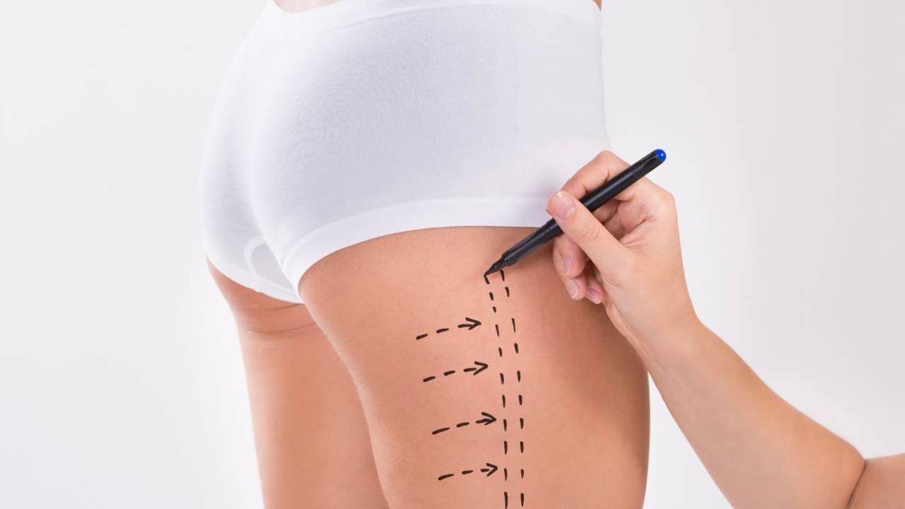 As cirurgias de lipoaspiração além do abdômen são recomendadas para retirada de gordura localizada